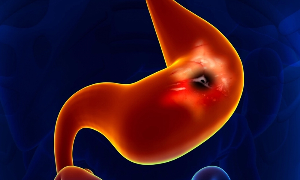 Mide Kanseri Ameliyatı