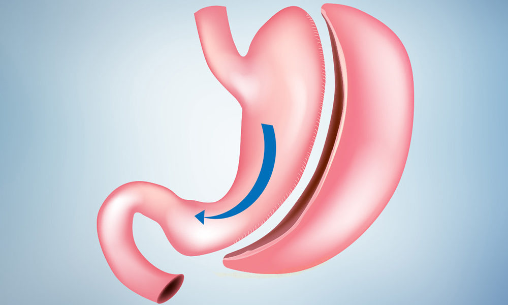 Tüp Mide Ameliyatı